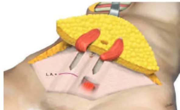 Figure 2 – Schematic appearance of the dissected and everted  cutaneous lap, as well as of both the rectus muscles dissected  from their beds to the limit of the arcuate line and sutured  