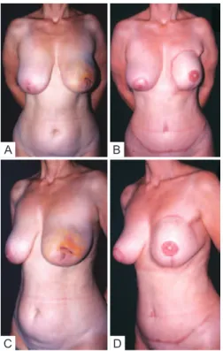 Figure 9  – A 36-year-old patient who underwent right mastectomy  2 years before, via a transverse incision, with partial preservation of 