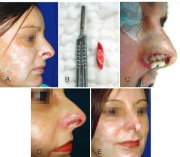 Figure 2 – Case 2. In A and B, preoperative appearance   of nasal alar sequelae caused by a human bite