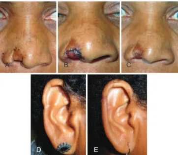 Figure 3 – Case 3. In A, preoperative appearance of nasal alar  sequelae caused by a human bite