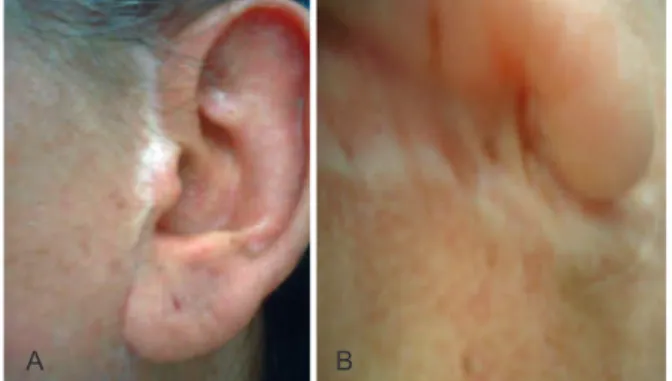Figure 1 – Types of scar ruptures frequently found in late  postoperative rhytidoplasties, which already evolve into  complications when they are noted