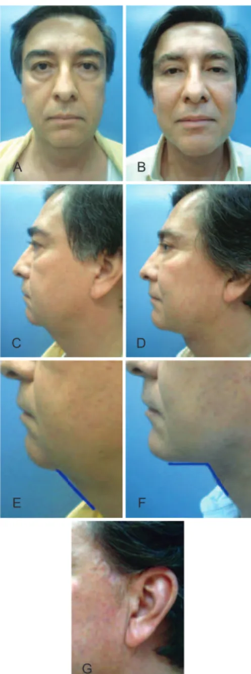 Figure 8 – In A and B, proile views of a 50-year-old patient,  preoperatively and 3 years postoperatively, who underwent  rhytidoplasty with the method described