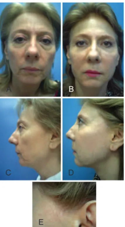 Figure 11 – In A , immediate postoperative image of small skin  folds in the preauricular region because of the procedure employed