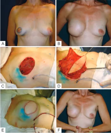 Figure 9 – In A, patient with ductal carcinoma in situ,   multifocal, showing both biopsied areas that were resected   en bloc