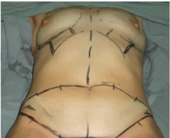 Figure 1 – Preoperative marking.