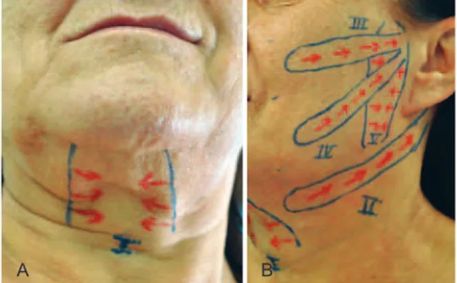 Figure 1 – In A, demarcation of vector I for treatment of the  platysma in the midcervical region, by 2 parallel and vertical lines 
