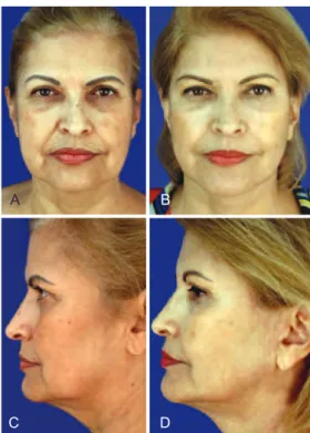Figure 9 – Orientation of the 3 vectors sutured   in the middle segment of the face.