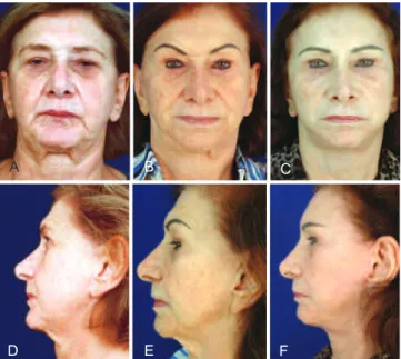 Figure 14 – Patient submitted to blepharoplasty and rhytidoplasty  at 79 years old, without treatment of SMAS