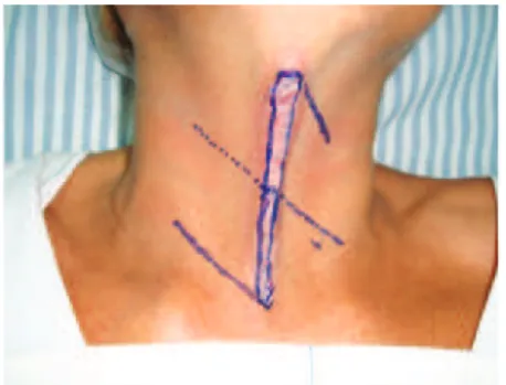 Figure 1 – Preoperative appearance. Marking of the   resection line and surgical plane.