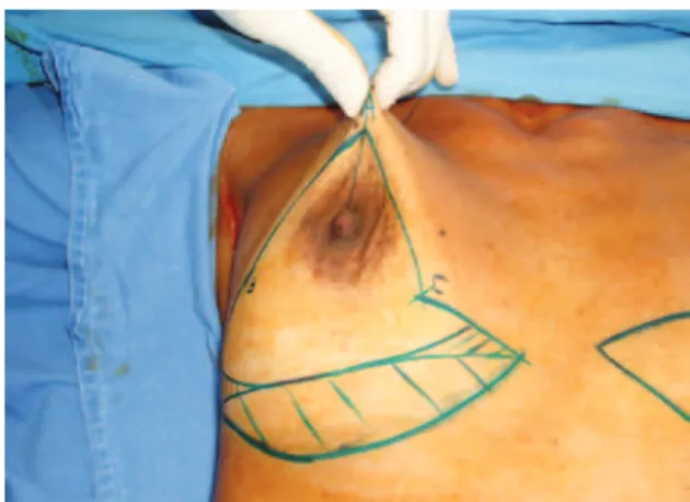 Figure 1 – Marking using the Longacre technique   plus areas A, B, and C proposed in this paper.