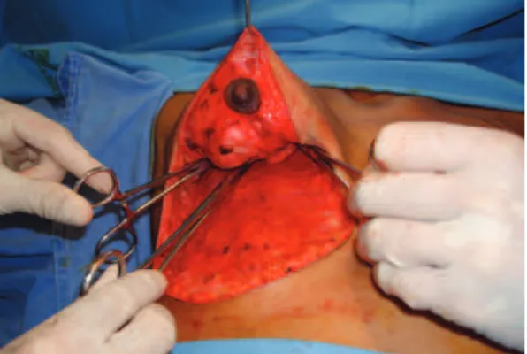 Figure 10 – Suturing of the deep layers to   eliminate the dead space.