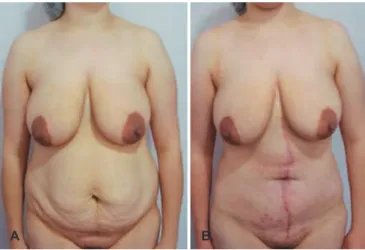 Figure 4 – After resection and plication.