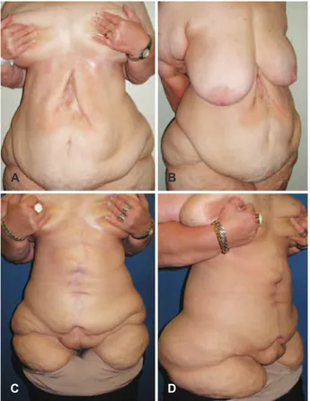 Figure 6 – In A and B, preoperative appearance,   in frontal and side views, respectively