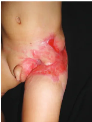 Figure 3 – Final appearance after surgical debridement. 2 more  debridement procedures were needed to ensure a receptive  