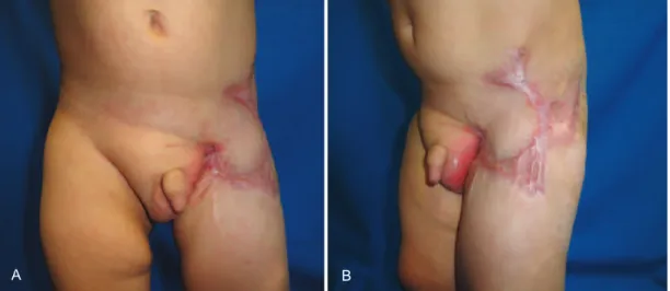 Figure 5 – Six-month postoperative appearance. In A, frontal view. In B, oblique view