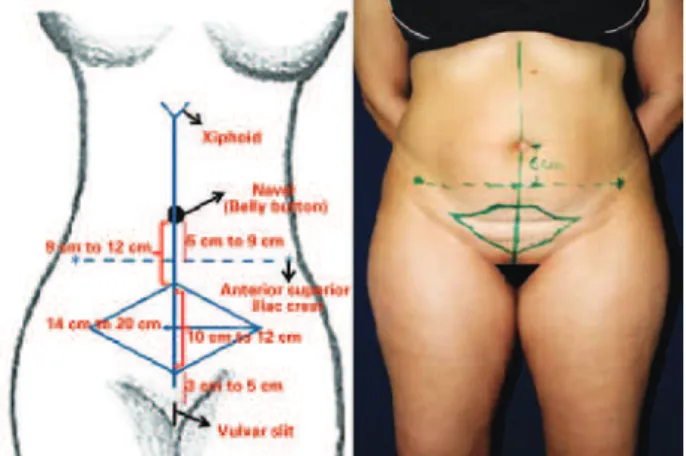 Figure 1 – Marking of the midline, beginning in the vulvar slit   to the xiphoid process