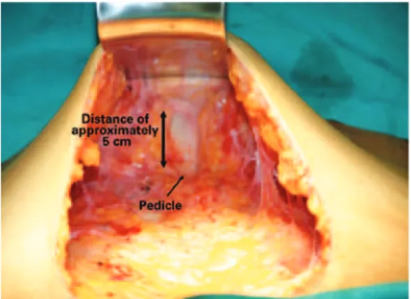 Figure 2 – Resection of the skin. Appearance of the   navel before attachment.