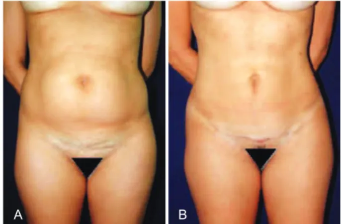Figure 6 – Navel already attached in the lower portion,   lowered by 3 to 5 cm. Fixing the navel in place previously marked 