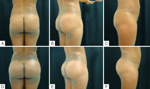 Figure 1 – Case 1. In A, B, and C, preoperative aspects. In D, E, and F, 45 days   after augmentation gluteoplasty with 400-mL Quartzo ®  type implants