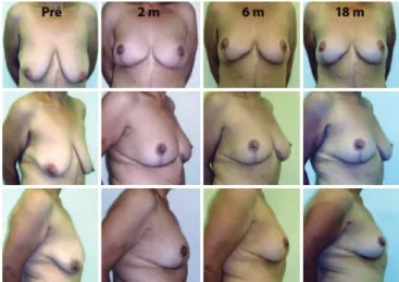 Figure 6 – Evolution up to 18 postoperative months after  mastopexy for massive weight loss