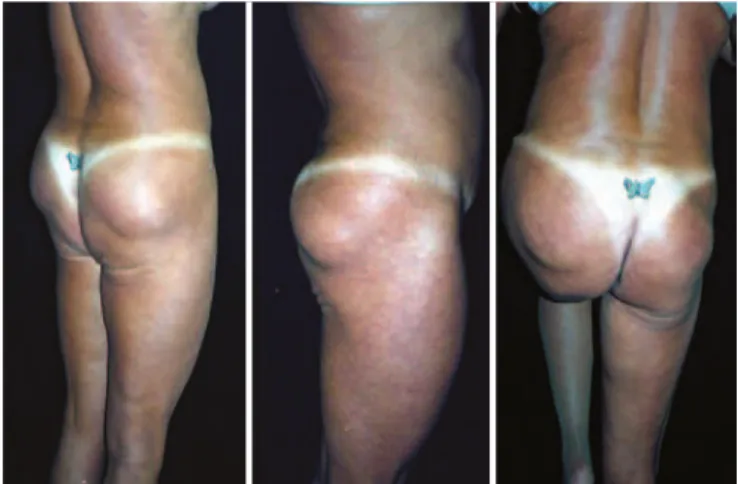 Figure 1 – Case 1. Postoperative image 7 years after the   insertion of silicone implants in the gluteal region performed  