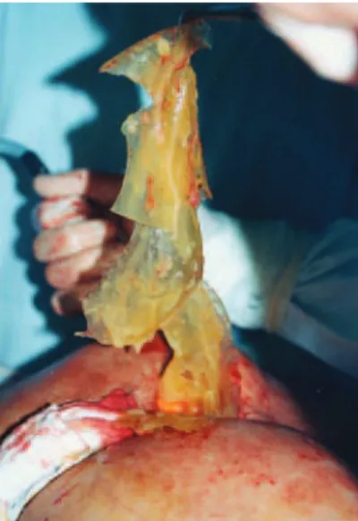 Figure 3 – Case 2. Intraoperative appearance during surgery to  replace gluteal implants 5 years after the irst surgery.