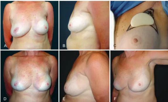 Figure 1 – In A and B, preoperative appearance of semilunar silicone supplementary implants