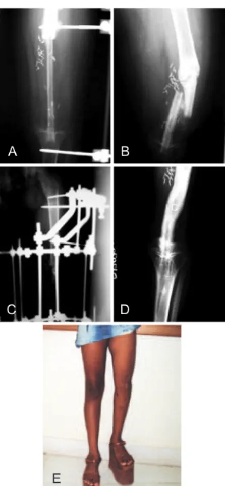 Figure 1 – Case 2. In A, osteosarcoma of the left femur.  