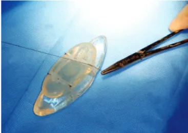 Figure 7 – Suture in the implant elastomer.