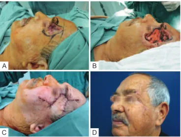 Figure 3 – Patient with wide tumoral lesion in the left   temporal-zygomatic region. In A, preoperative appearance