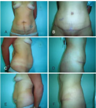 Figure 13 – A patient who underwent lipoabdominoplasty for  aesthetic treatment of the abdomen