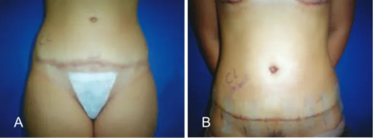 Figure 19 – In A, preoperative appearance before scar correction. 