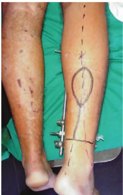 Figure 1  – Marking the graft. The rotation point is 5 cm above   the lateral malleolus (the limit for dissection of the pedicle)