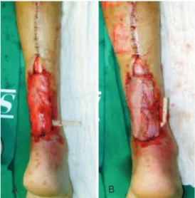 Figure 7 – A lap transposed through a subcutaneous tunnel.  