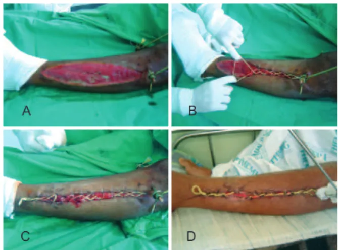 Figure 1 – In A, fasciotomy of the lower limb.  