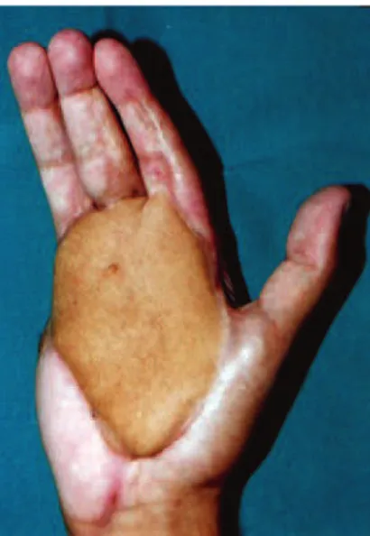 Figure 4 – Dorsum of the foot and ankle covered with   a latissimus dorsi lap.