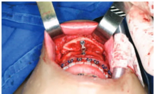 Figure 1 – Intraoperative aspect showing horizontal chin  advancement using sliding genioplasty and ixation with  