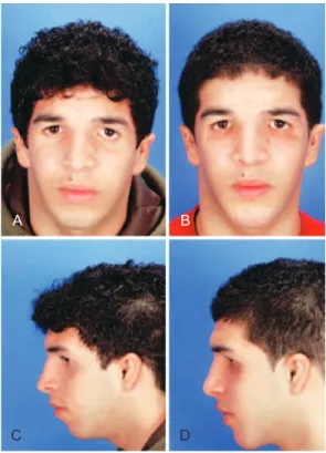 Figure 3 – In A and C, frontal view and right proile, respectively,  of a patient with Crouzon syndrome showing hypomentonism 