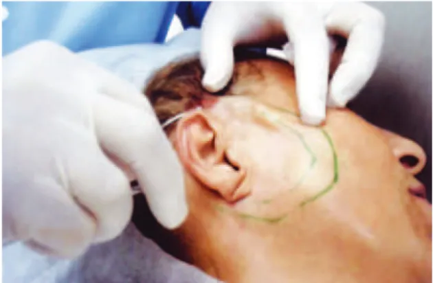 Figure 2 – Marking of the passage of the suspension thread and  beginning of anesthetic iniltration.