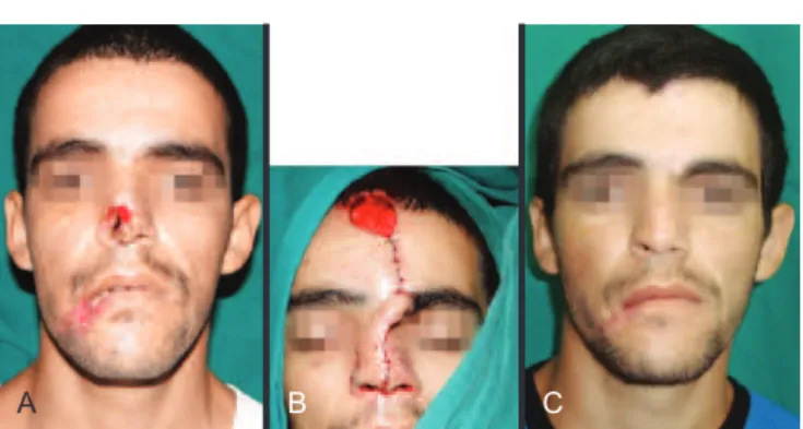 Figure 5 –  Male 27-year-old patient. In  A , preoperative  appearance, showing extensive nasal substance loss following 