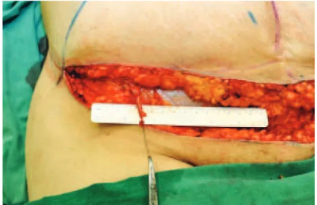 Figure 4 – Close-up view of an end-to-end anastomosis of the  supericial inferior epigastric artery from both sides.