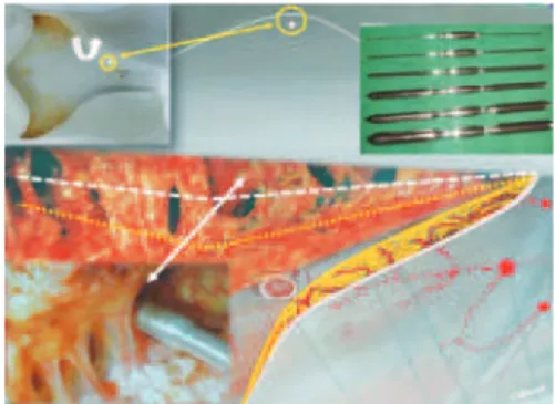 Figure 4  – In  A and B , details of the abdominal skin lap are  shown, which was dissected until the pubic area, with a triangular 