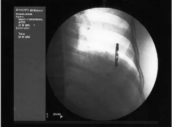 Figure 3 – Proile view of the broken segment   of the cannula against the ribs.