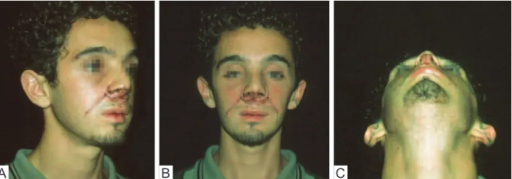 Figure 1 – Pre-operative appearance. In A, half right proile, absence of columella.  