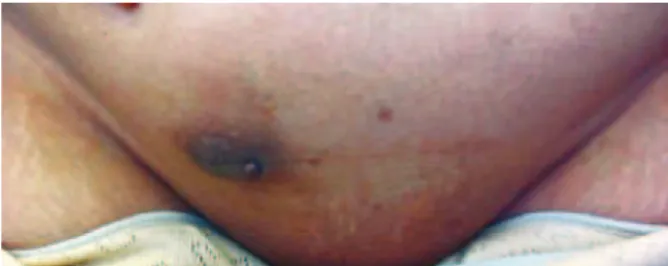 Figure 2 – In A, B, and C show multiple micronodules   composed of benign endometrial glands and stroma within the 