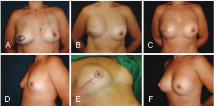 Figure 14 – A patient in which the repositioning of the   prosthesis and NAC reconstruction were performed at the   same surgical time