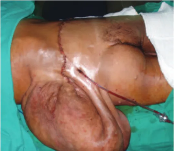 Figure 4 – Transoperative appearance,  posterior view.