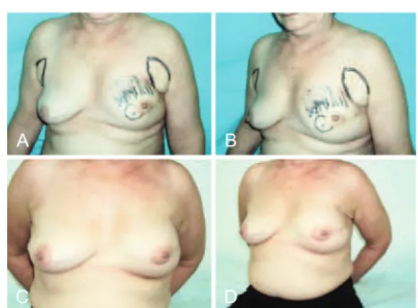 Table 1  – Lipoilling by reconstruction type.