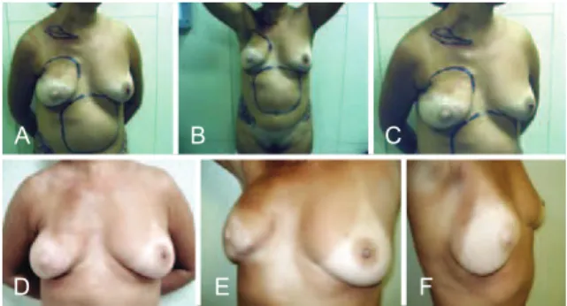 Figure 9 – In A, preoperative appearance of the markings in the  area to be grafted in the left breast (left oblique view)