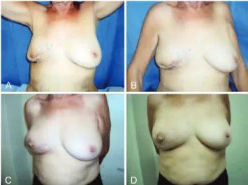 Figure 13 – In A and B, preoperative appearance   of markings on the right breast (frontal view)